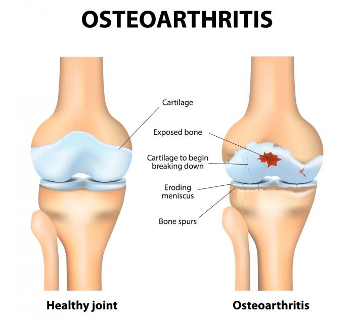 diagram-of-osteoarthritis-in-knee-joint.jpg