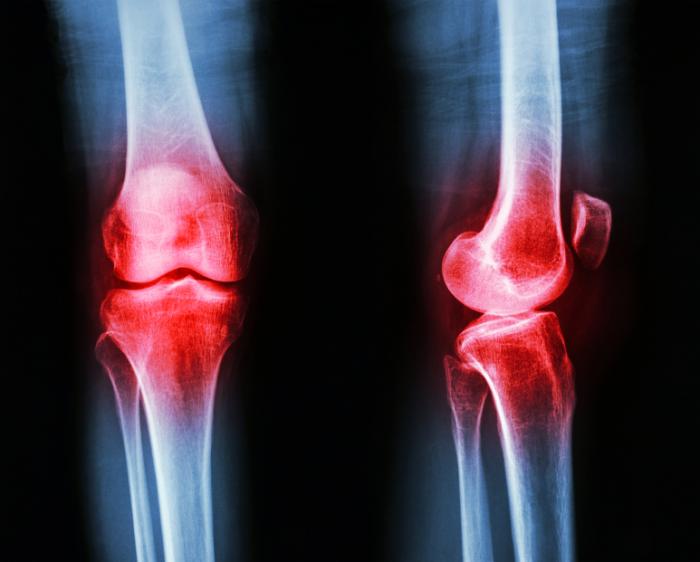 osteoarthritis-of-the-knee.jpg