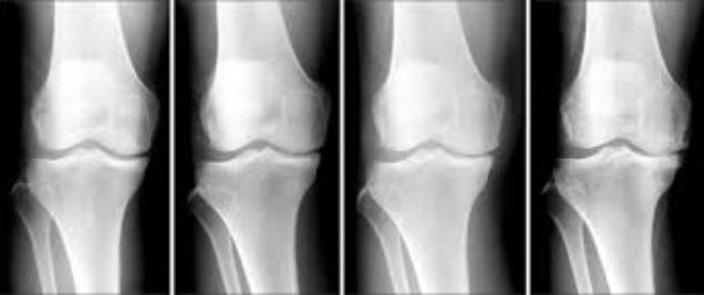 knee-deformity1.jpg