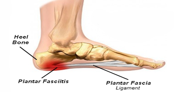 plantar-fasciitis-or-joggers-heel-how-to-get-rid-of-the-pain-in-the-heel-600x320.png
