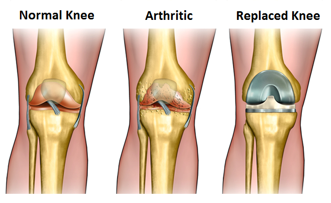total-knee-replacement-medifee.png