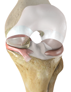 nusurface-meniscus-implant-231x300.png