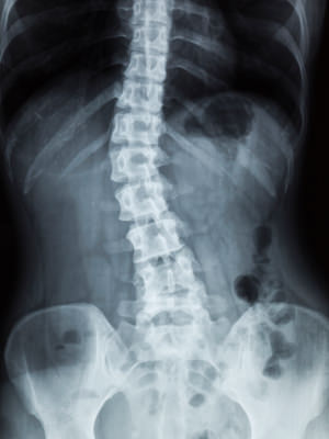 Scoliosis-Lumbar-spine.jpg