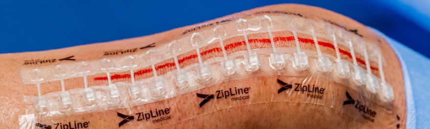 zipline-medical-surgical-skin-closure.jpg