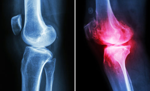 osteoarthritis-knee-pain-e1490217086369.jpg