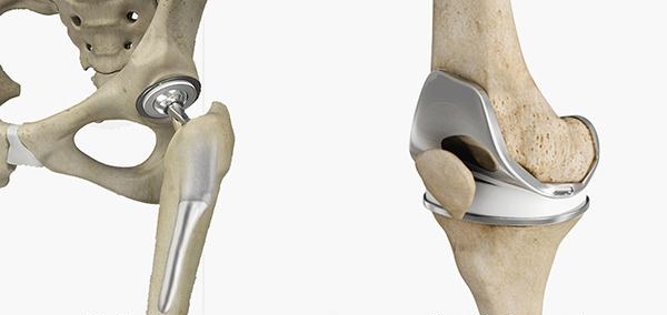 hip-and-knee-replacement-12bto.jpg