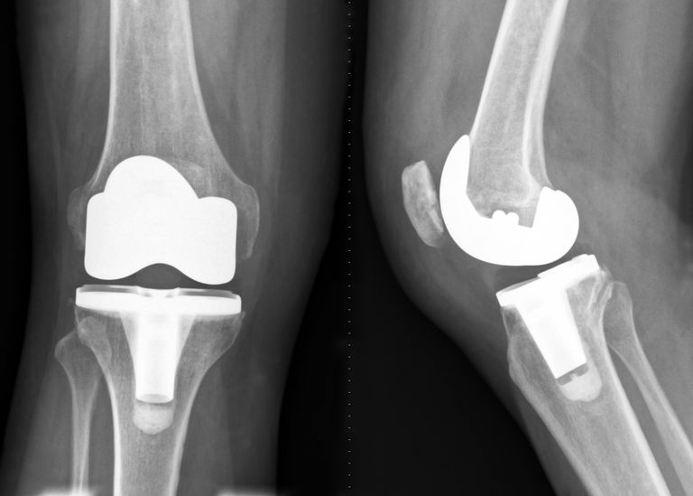 total-knee-replacement-123663788-5b01c724642dca0037c139a9.jpg