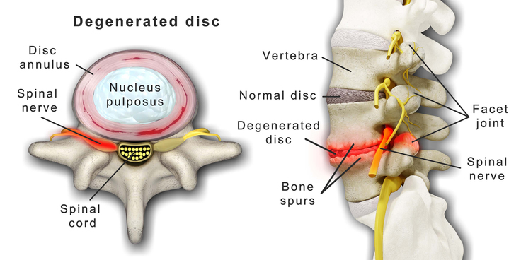 large_spine_degenerative_disc_disease_01.jpg