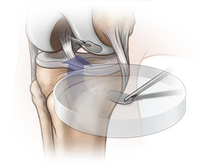 knee_illustration_04.png