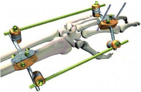 Fig-4-Stryker-C-system-illustrating-a-bridging-external-fixator-used-for-distal-radius.png