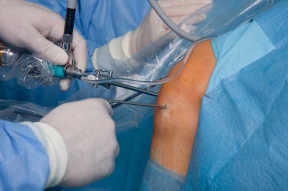 arthroscopy-knee.jpg