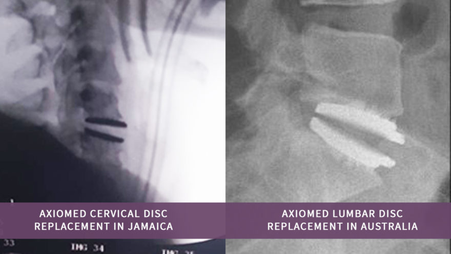 AxioMedCervicalLumbarAUSJA.jpg