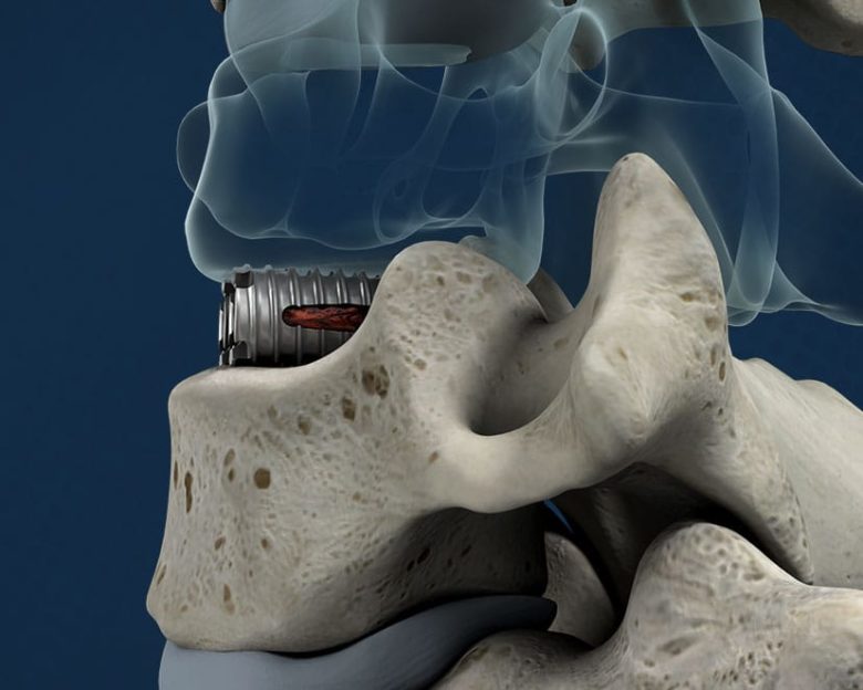 Wenzel Spine Announces Refinements and Extended Size Range of the ...