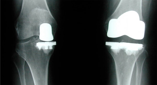 partialvstotalkneereplacement2.jpg