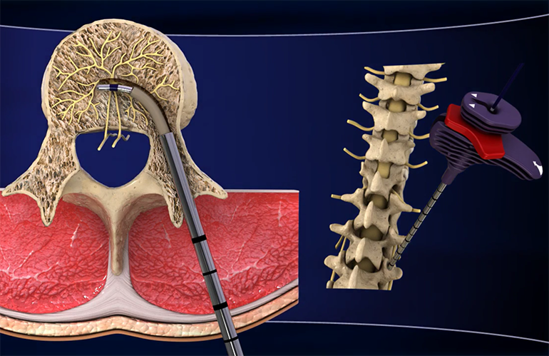 spinal-ablation.png