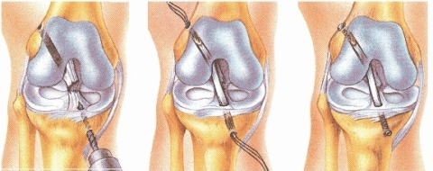 Figure_2_-_Example_of_ACL_reconstruction_using_CelGro®_collagen_rope.jpg
