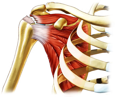 rotator_cuff_tear-1.jpg