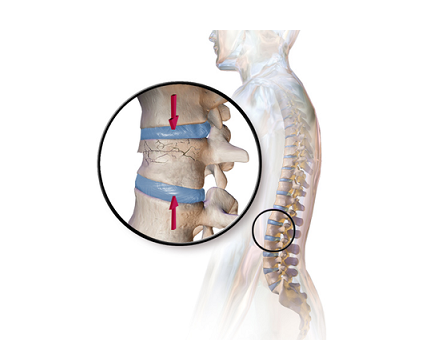 300px-Blausen_0250_CompressionFracture_Vertebrae-12.png