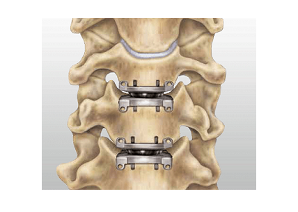 neck-surgery-750x750-12bto.png