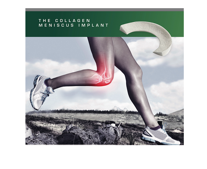 Collagen-Meniscus-Implant-Photo-12bto2.png