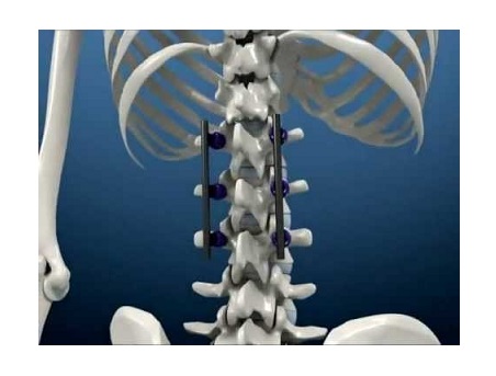 Pedicle-Screw-Systems-Market-12bto.jpg