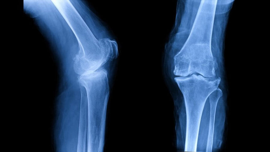 osteoarthritis-oa-knee-film-xray_shutterstock_756734566-900x506.jpg